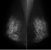 乳腺X線写真（正常）