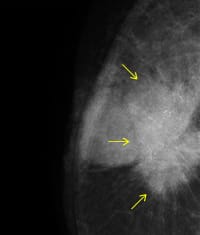 乳腺X線写真（乳がん）
